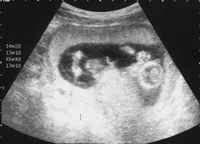 妊娠14週目の超音波写真